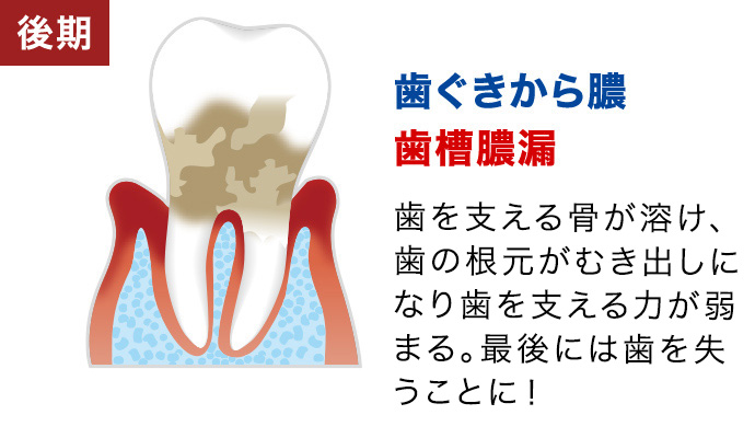 【後期：歯ぐきから膿 歯槽膿漏】末期症状で、歯の根元がむき出しになる。最後に歯を失うことに！
