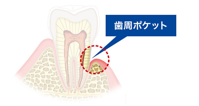膿 漏 歯磨き粉 歯槽