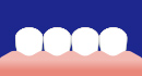 前歯など歯と歯の隙間が特に狭いところ