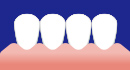 軽度の歯茎の退縮部位や歯並びの悪いところ