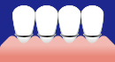 歯茎の退縮部位やブリッジ装着の周辺など