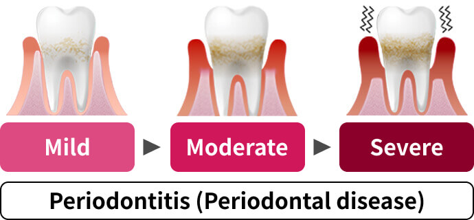 Periodontitis (Periodontal disease) Mild Moderate Severe