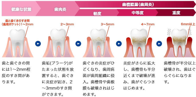 健康な状態 歯と歯ぐきの間には1~2mm程度のすき間があります。歯肉炎 歯垢(プラーク)がたまった状態を放置すると、歯ぐきに炎症が起き、2~3mmのすき間ができます。歯槽膿漏(歯肉炎) 軽度 歯ぐきの炎症がひどくなり、歯周病菌が歯周組織に侵入。歯槽骨や歯根膜も破壊されはじめます。中等度 炎症がさらに拡大し、歯槽骨も半分近くまで破壊が進み、歯がぐらつきはじめます。重度 歯槽骨が半分以上破壊され、歯はぐらぐらになります。