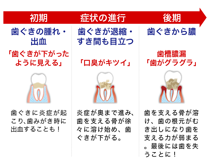 初期の歯周病から歯槽膿漏になる進行過程