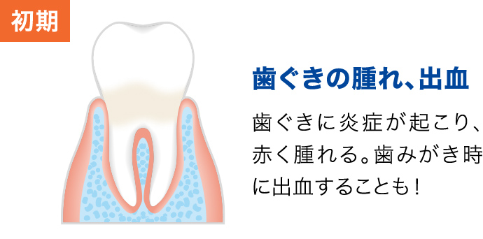 【初期：歯ぐきの腫れ、出血】歯ぐきに炎症が起こり、赤く腫れる。歯みがき時に出血することも！