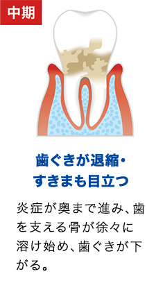 【中期：歯ぐきが退縮・ すきまも目立つ】炎症が奥まで進み、赤みが増して更に腫れがひどくなる。歯周病を自覚し意識する。