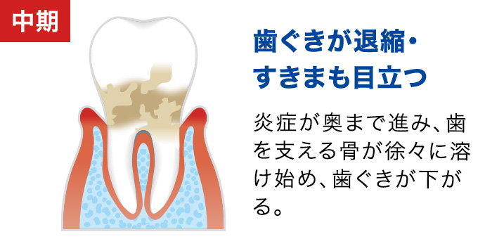 【中期：歯ぐきが退縮・ すきまも目立つ】炎症が奥まで進み、赤みが増して更に腫れがひどくなる。歯周病を自覚し意識する。