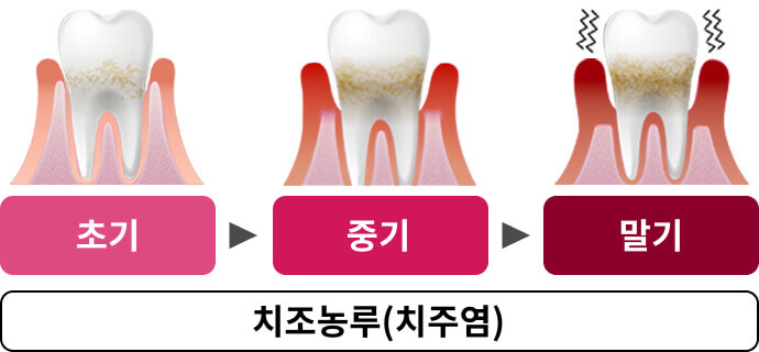 초기 중기 말기 치조농루(치주염)