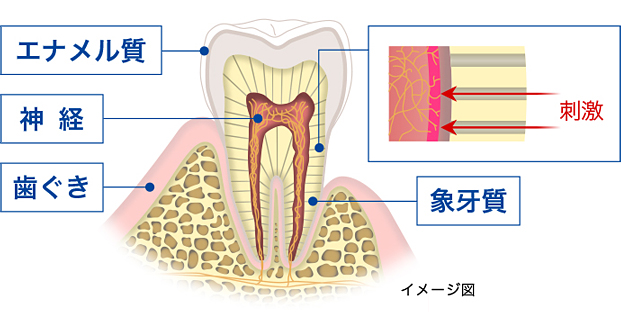歯牙質が露出する「象牙質知覚過敏」と呼ばれる症状の可能性があります。