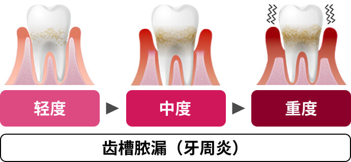 轻度 中度 重度 齿槽脓漏（牙周炎）