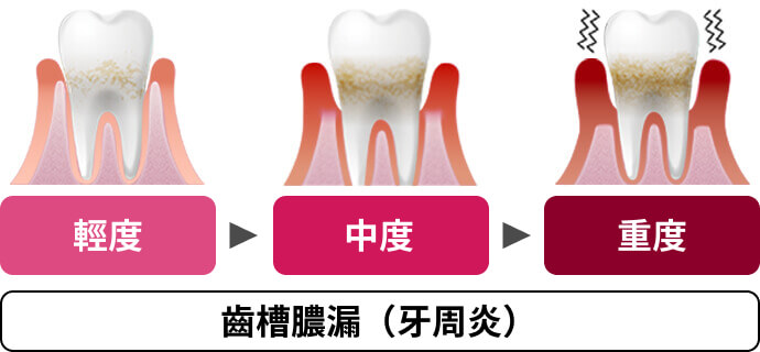 輕度 中度 重度 齒槽膿漏（牙周炎）