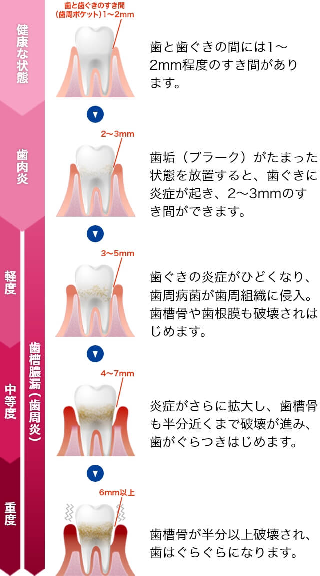 健康な状態 歯と歯ぐきの間には1~2mm程度のすき間があります。歯肉炎 歯垢(プラーク)がたまった状態を放置すると、歯ぐきに炎症が起き、2~3mmのすき間ができます。歯槽膿漏(歯肉炎) 軽度 歯ぐきの炎症がひどくなり、歯周病菌が歯周組織に侵入。歯槽骨や歯根膜も破壊されはじめます。中等度 炎症がさらに拡大し、歯槽骨も半分近くまで破壊が進み、歯がぐらつきはじめます。重度 歯槽骨が半分以上破壊され、歯はぐらぐらになります。